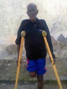 Dr. Mohamed Ali Nur lost his leg during the civil war in Somalia.