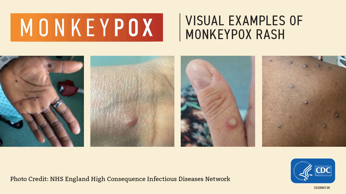 An infographic with pictures of rashes caused by monkeypox